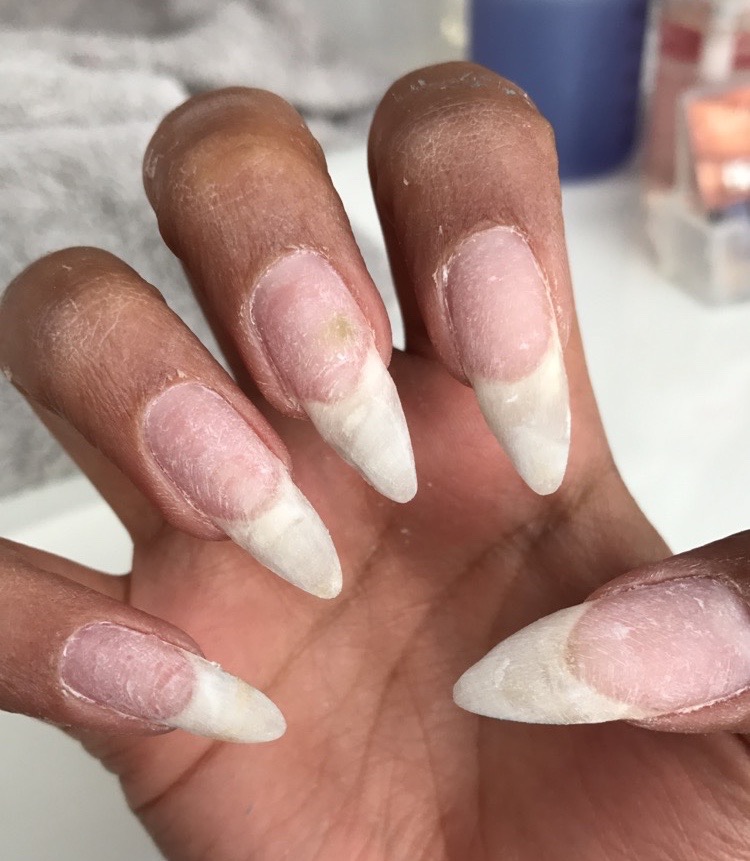 Natural Nails after Acrylic Overlay for 6 Months